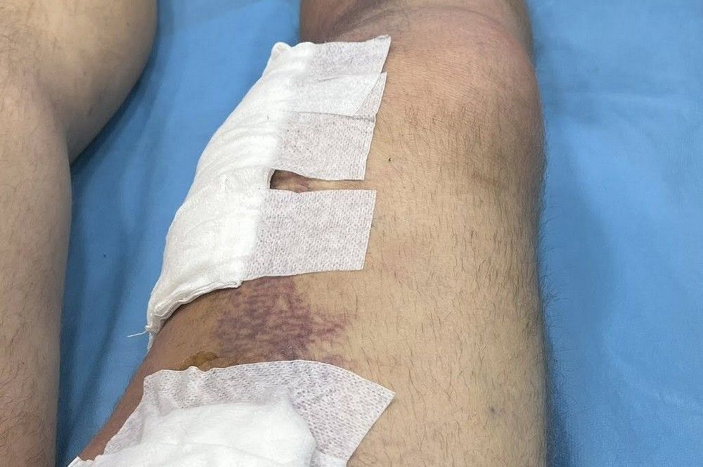 Hajszálon múlt a végtagamputáció. Újabb fontos beavatkozás a Szatmár Megyei Sürgősségi Kórházban